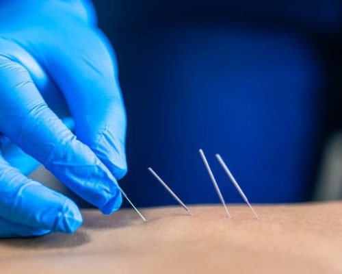 Close up of a needle and hands of physiotherapist doing a dry needling in a physiotherapy center.